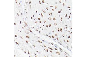 Immunohistochemistry of paraffin-embedded human esophageal cancer using LEO1 Rabbit pAb (ABIN6133790, ABIN6143141 and ABIN7101832) at dilution of 1:100 (40x lens). (LEO1 antibody)