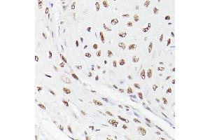 Immunohistochemistry of paraffin-embedded human esophageal cancer using LEO1 Rabbit pAb (ABIN6133790, ABIN6143141 and ABIN7101832) at dilution of 1:100 (40x lens). (LEO1 antibody)