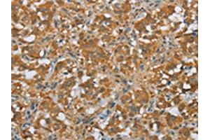 The image on the left is immunohistochemistry of paraffin-embedded Human thyroid cancer tissue using ABIN7190675(FOXB1 Antibody) at dilution 1/30, on the right is treated with synthetic peptide. (FOXB1 antibody)