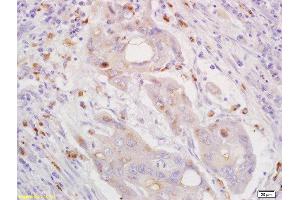 Formalin-fixed and paraffin embedded human lung carcinoma labeled with Rabbit Anti CXorf36 Polyclonal Antibody, Unconjugated  at 1:200 followed by conjugation to the secondary antibody and DAB staining (CXORF36 antibody  (AA 91-182))