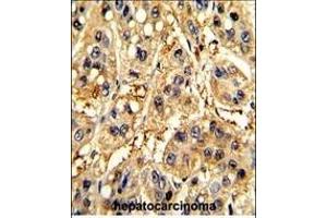 Formalin-fixed and paraffin-embedded human hepatocarcinoma with SFRP5 Antibody (Center), which was peroxidase-conjugated to the secondary antibody, followed by DAB staining. (SFRP5 antibody  (AA 219-248))