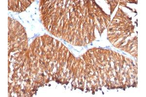 Formalin-fixed, paraffin-embedded human Bladder Carcinoma stained with HSP60 Mouse Monoclonal Antibody (HSPD1/780) (HSPD1 antibody)