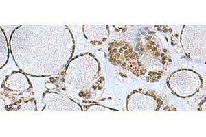 Immunohistochemistry of paraffin-embedded Human thyroid cancer tissue using PTPA Polyclonal Antibody at dilution of 1:50(x200) (PPP2R4 antibody)