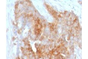 IHC testing of FFPE human ovarian carcinoma with Fascin antibody (clone FAN55-1)