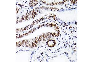 Immunohistochemistry of paraffin-embedded human colon carcinoma using MCM2 Rabbit mAb (ABIN7268538) at dilution of 1:100 (40x lens).