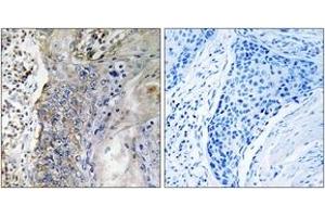 Immunohistochemistry analysis of paraffin-embedded human lung carcinoma tissue, using SLC28A2 Antibody. (SLC28A2 antibody  (AA 371-420))