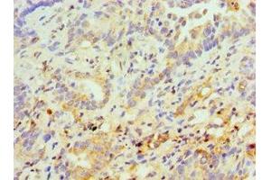 Immunohistochemistry of paraffin-embedded human lung cancer using ABIN7158299 at dilution of 1:100 (CD43 antibody  (AA 276-400))
