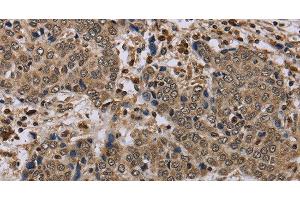 Immunohistochemistry of paraffin-embedded Human liver cancer tissue using NLRP4 Polyclonal Antibody at dilution 1:40 (NLRP4 antibody)