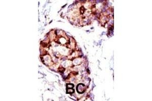 Formalin-fixed and paraffin-embedded human cancer tissue reacted with the primary antibody, which was peroxidase-conjugated to the secondary antibody, followed by AEC staining. (TSG101 antibody  (N-Term))