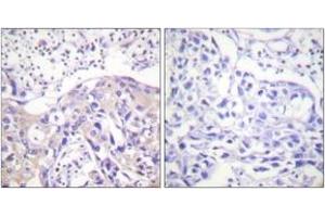 Immunohistochemistry analysis of paraffin-embedded human breast carcinoma, using ADD1 (Phospho-Thr445) Antibody. (alpha Adducin antibody  (pThr445))