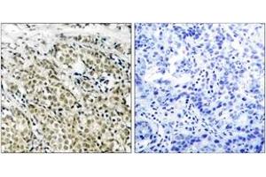 Immunohistochemistry analysis of paraffin-embedded human prostate carcinoma, using Androgen Receptor (Ab-213) Antibody. (Androgen Receptor antibody  (AA 186-235))