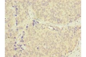Immunohistochemistry of paraffin-embedded human gastric cancer using ABIN7173631 at dilution of 1:100 (TSACC/C1orf182 antibody  (AA 1-125))