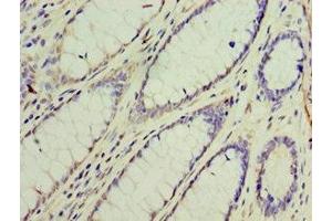Immunohistochemistry of paraffin-embedded human colon cancer using ABIN7154312 at dilution of 1:100 (GS28 antibody  (AA 1-115))