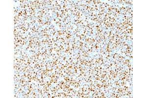IHC testing of human mantle cell lymphoma stained with Cyclin D1 antibody. (Cyclin D1 antibody)