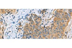 Immunohistochemistry of paraffin-embedded Human cervical cancer tissue using PSMA6 Polyclonal Antibody at dilution of 1:90(x200) (PSMA6 antibody)
