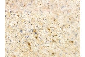 ABIN6261315 and ABIN6266717 at 1/100 staining human astrocytoma by IHC-P. (DLX3 antibody  (Internal Region))