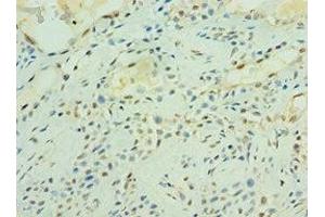 Immunohistochemistry of paraffin-embedded human breast cancer using ABIN7166484 at dilution of 1:100 (MAS1 antibody  (AA 246-325))