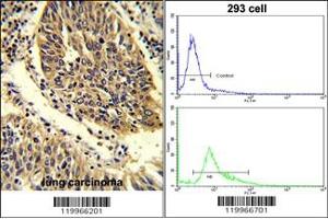 (LEFT)Formalin-fixed and paraffin-embedded human lung carcinoma reacted with WNT4 Antibody (C-term), which was peroxidase-conjugated to the secondary antibody, followed by DAB staining.