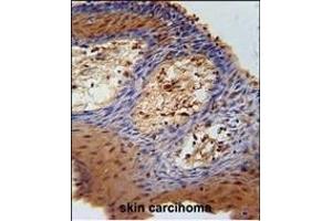 DHRS2 Antibody (C-term) (ABIN651532 and ABIN2840282) immunohistochemistry analysis in formalin fixed and paraffin embedded human skin carcinoma followed by peroxidase conjugation of the secondary antibody and DAB staining. (DHRS2 antibody  (C-Term))
