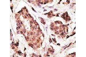 IHC analysis of FFPE human breast carcinoma tissue stained with the PGP9. (UCHL1 antibody  (AA 187-216))