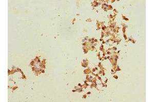 Immunohistochemistry of paraffin-embedded human breast cancer using ABIN7150598 at dilution of 1:100