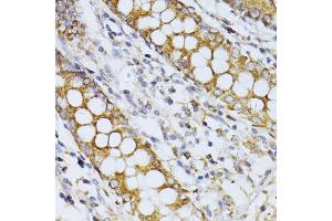 Immunohistochemistry of paraffin-embedded human colon using CCDC92 antibody (ABIN5974817) at dilution of 1/100 (40x lens). (CCDC92 antibody)