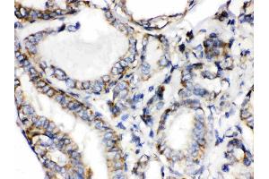 Calcitonin was detected in paraffin-embedded sections of human thyroid cancer tissues using rabbit anti- Calcitonin Antigen Affinity purified polyclonal antibody (Catalog # ) at 1 ?