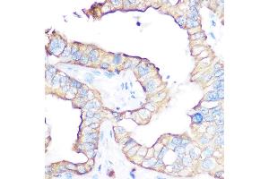 Immunohistochemistry of paraffin-embedded human liver cancer using CD47 antibody (ABIN6127604, ABIN6138199, ABIN6138201 and ABIN6223104) at dilution of 1:100 (40x lens).