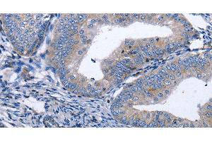 Immunohistochemistry of paraffin-embedded Human cervical cancer tissue using BDNF Polyclonal Antibody at dilution 1:40 (BDNF antibody)
