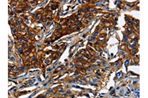 The image on the left is immunohistochemistry of paraffin-embedded Human lung cancer tissue using ABIN7189591(ABCC5 Antibody) at dilution 1/50, on the right is treated with synthetic peptide. (ABCC5 antibody)