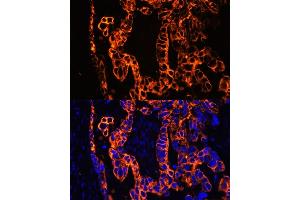 Immunofluorescence analysis of human lung cancer using Cytokeratin 7 (Cytokeratin 7 (KRT7)) antibody (ABIN6129292, ABIN6143037, ABIN6143039 and ABIN6215559) at dilution of 1:100. (Cytokeratin 7 antibody  (AA 1-94))