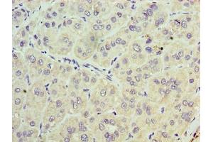 Immunohistochemistry of paraffin-embedded human liver cancer using ABIN7171285 at dilution of 1:100 (TRBC1 antibody  (AA 1-176))