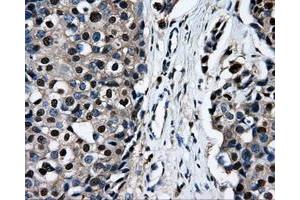 Immunohistochemical staining of paraffin-embedded Adenocarcinoma of ovary tissue using anti-RALBP1mouse monoclonal antibody.