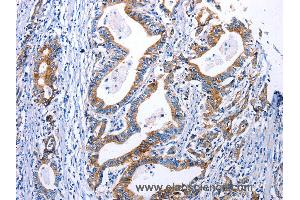 Immunohistochemistry of Human gastric cancer using DRD4 Polyclonal Antibody at dilution of 1:30 (DRD4 antibody)
