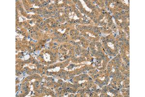 Immunohistochemistry of Human thyroid cancer using SEC14L2 Polyclonal Antibody at dilution of 1:40