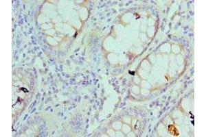 Immunohistochemistry of paraffin-embedded human colon cancer using ABIN7142558 at dilution of 1:100 (RPS4X antibody  (AA 66-263))