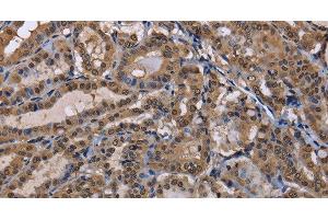 Immunohistochemistry of paraffin-embedded Human thyroid cancer using CUL3 Polyclonal Antibody at dilution of 1:30 (Cullin 3 antibody)
