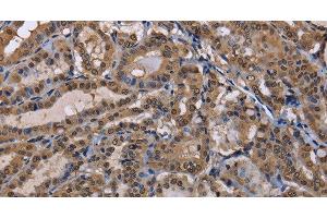 Immunohistochemistry of paraffin-embedded Human thyroid cancer using CUL3 Polyclonal Antibody at dilution of 1:30