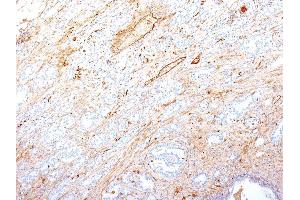 Formalin-fixed, paraffin-embedded human Pancreatic Adenocarcinoma stained with Fibronectin Monoclonal Antibody (SPM246).