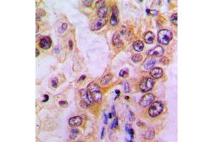 Immunohistochemical analysis of EHHADH staining in human liver cancer formalin fixed paraffin embedded tissue section. (EHHADH antibody  (Center))