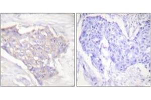 Immunohistochemistry analysis of paraffin-embedded human breast carcinoma tissue, using BIM Antibody. (BIM antibody  (AA 1-50))