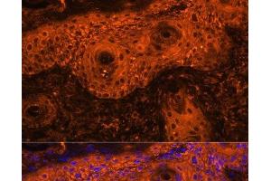 Immunofluorescence analysis of Human skin cancer using TYR Polyclonal Antibody at dilution of 1:100. (TYR antibody)