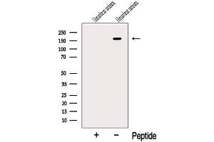 Western blot analysis of extracts from Human breast carcinoma tissue, using RAB3GAP2 Antibody. (RAB3GAP2 antibody  (Internal Region))