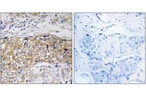 Immunohistochemistry analysis of paraffin-embedded human breast carcinoma tissue, using USP24 Antibody. (USP24 antibody  (AA 21-70))