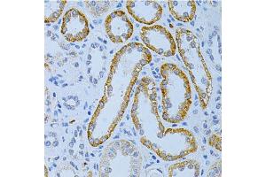 Immunohistochemistry of paraffin-embedded human kidney cancer using MAP2 Antibody. (MAP2 antibody)