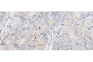 Immunohistochemistry of paraffin-embedded Human colorectal cancer tissue using APOBR Polyclonal Antibody at dilution of 1:35(x200) (APOBR antibody)