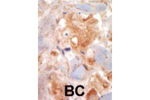 Immunohistochemistry (IHC) image for anti-Mast/stem Cell Growth Factor Receptor (KIT) antibody (ABIN5014921) (KIT antibody)