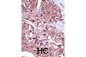 Formalin-fixed and paraffin-embedded human hepatocellular carcinoma tissue reacted with ACVRL1 polyclonal antibody  , which was peroxidase-conjugated to the secondary antibody, followed by DAB staining.