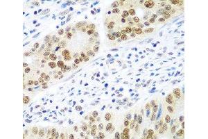 Immunohistochemistry of paraffin-embedded Human colon carcinoma using MDC1 Polyclonal Antibody at dilution of 1:100 (40x lens). (MDC1 antibody)