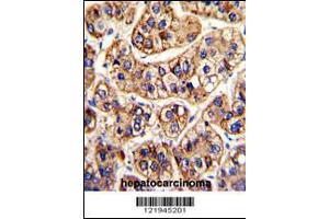 Formalin-fixed and paraffin-embedded human hepatocarcinoma with IFNAR1 Antibody , which was peroxidase-conjugated to the secondary antibody, followed by DAB staining. (IFNAR1 antibody  (AA 162-188))